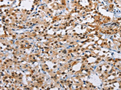 The image on the left is immunohistochemistry of paraffin-embedded Human thyroid cancer tissue using the antibody Antibody) at dilution 1/40, on the right is treated with fusion protein. (Original magnification: ×200)