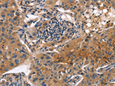 The image on the left is immunohistochemistry of paraffin-embedded Human lung cancer tissue using ITGB3 Antibody(ITGB3 Antibody) at dilution 1/20, on the right is treated with fusion protein. (Original magnification: ×200)