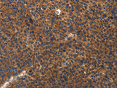 The image on the left is immunohistochemistry of paraffin-embedded Human liver cancer tissue using the antibody Antibody) at dilution 1/20, on the right is treated with fusion protein. (Original magnification: ×200)