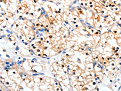 The image on the left is immunohistochemistry of paraffin-embedded Human renal cancer tissue using RALB Antibody(RALB Antibody) at dilution 1/10, on the right is treated with synthetic peptide. (Original magnification: ×200)Rabbit anti-Human RALB Polyclonal Antibody