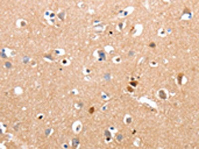 The image on the left is immunohistochemistry of paraffin-embedded Human brain tissue using the antibody Antibody) at dilution 1/10, on the right is treated with synthetic peptide. (Original magnification: ×200)Rabbit anti-Human RALB Polyclonal Antibody