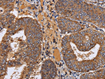 The image on the left is immunohistochemistry of paraffin-embedded Human colon cancer tissue using NDUFA1 Antibody(NDUFA1 Antibody) at dilution 1/70, on the right is treated with fusion protein. (Original magnification: ×200)Rabbit anti-Human NDUFA1 Polyclonal Antibody