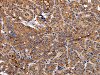 The image on the left is immunohistochemistry of paraffin-embedded Human thyroid cancer tissue using the antibody Antibody) at dilution 1/70, on the right is treated with fusion protein. (Original magnification: ×200)Rabbit anti-Human NDUFA1 Polyclonal Antibody