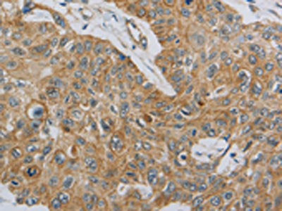 The image on the left is immunohistochemistry of paraffin-embedded Human esophagus cancer tissue using MMP8 Antibody(MMP8 Antibody) at dilution 1/45, on the right is treated with synthetic peptide. (Original magnification: ×200)Rabbit anti-Human MMP8 Polyclonal Antibody