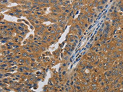 The image on the left is immunohistochemistry of paraffin-embedded Human ovarian cancer tissue using the antibody Antibody) at dilution 1/45, on the right is treated with synthetic peptide. (Original magnification: ×200)