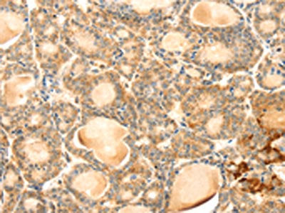 The image on the left is immunohistochemistry of paraffin-embedded Human thyroid cancer tissue using EVA1A Antibody(EVA1A Antibody) at dilution 1/30, on the right is treated with synthetic peptide. (Original magnification: ×200)Rabbit anti-Human EVA1A Polyclonal Antibody