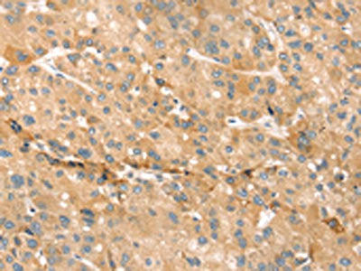 The image on the left is immunohistochemistry of paraffin-embedded Human liver cancer tissue using the antibody Antibody) at dilution 1/30, on the right is treated with synthetic peptide. (Original magnification: ×200)Rabbit anti-Human EVA1A Polyclonal Antibody