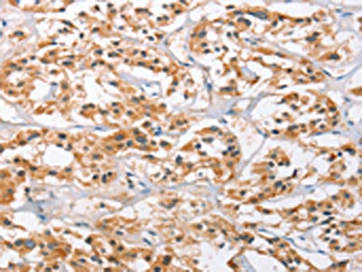 The image on the left is immunohistochemistry of paraffin-embedded Human thyroid cancer tissue using CAMK4 Antibody(CAMK4 Antibody) at dilution 1/20, on the right is treated with fusion protein. (Original magnification: ×200)