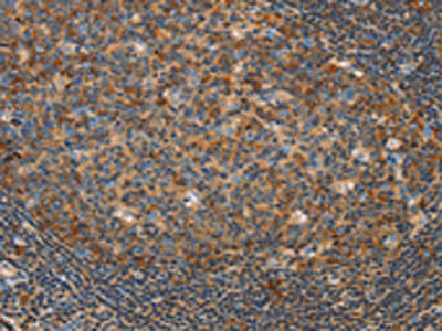 The image on the left is immunohistochemistry of paraffin-embedded Human tonsil tissue using the antibody Antibody) at dilution 1/20, on the right is treated with fusion protein. (Original magnification: ×200)