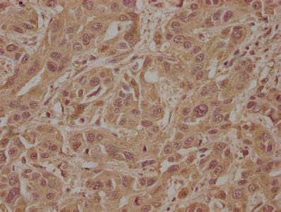 IHC image of SOS2 Antibody diluted at 1:100 and staining in paraffin-embedded human liver cancer performed on a Leica BondTM system. After dewaxing and hydration, antigen retrieval was mediated by high pressure in a citrate buffer (pH 6.0). Section was blocked with 10% normal goat serum 30min at RT. Then primary antibody (1% BSA) was incubated at 4°C overnight. The primary is detected by a biotinylated secondary antibody and visualized using an HRP conjugated SP system.Rabbit anti-Human SOS2 Polyclonal Antibody