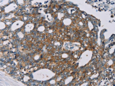 The image on the left is immunohistochemistry of paraffin-embedded Human cervical cancer tissue using MRPL39 Antibody(MRPL39 Antibody) at dilution 1/30, on the right is treated with fusion protein. (Original magnification: ×200)Rabbit anti-Human MRPL39 Polyclonal Antibody