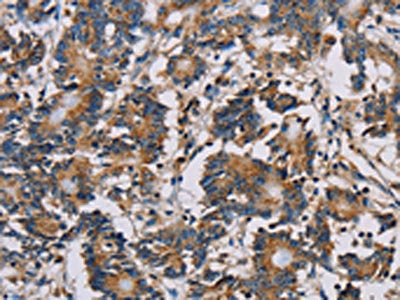 The image on the left is immunohistochemistry of paraffin-embedded Human colon cancer tissue using the antibody Antibody) at dilution 1/30, on the right is treated with fusion protein. (Original magnification: ×200)