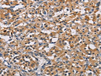 The image on the left is immunohistochemistry of paraffin-embedded Human thyroid cancer tissue using GPM6A Antibody(GPM6A Antibody) at dilution 1/50, on the right is treated with fusion protein. (Original magnification: ×200)Rabbit anti-Human GPM6A Polyclonal Antibody