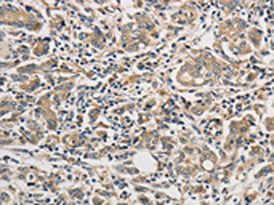 The image on the left is immunohistochemistry of paraffin-embedded Human gastric cancer tissue using PTPN11 Antibody(PTPN11 Antibody) at dilution 1/25, on the right is treated with fusion protein. (Original magnification: ×200)Rabbit anti-Human PTPN11 Polyclonal Antibody