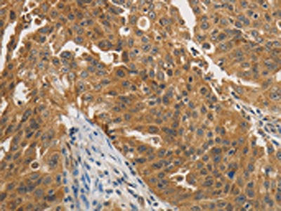 The image on the left is immunohistochemistry of paraffin-embedded Human ovarian cancer tissue using the antibody Antibody) at dilution 1/25, on the right is treated with fusion protein. (Original magnification: ×200)Rabbit anti-Human PTPN11 Polyclonal Antibody