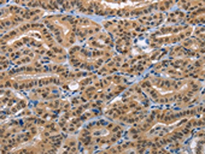 The image on the left is immunohistochemistry of paraffin-embedded Human thyroid cancer tissue using BAG1 Antibody(BAG1 Antibody) at dilution 1/20, on the right is treated with fusion protein. (Original magnification: ×200)