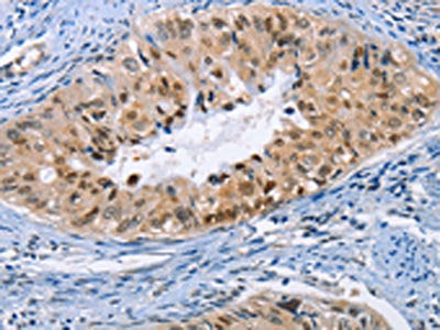 The image on the left is immunohistochemistry of paraffin-embedded Human cervical cancer tissue using the antibody Antibody) at dilution 1/20, on the right is treated with fusion protein. (Original magnification: ×200)