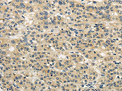 The image on the left is immunohistochemistry of paraffin-embedded Human liver cancer tissue using WDR91 Antibody(WDR91 Antibody) at dilution 1/20, on the right is treated with synthetic peptide. (Original magnification: ×200)Rabbit anti-Human WDR91 Polyclonal Antibody