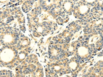 The image on the left is immunohistochemistry of paraffin-embedded Human thyroid cancer tissue using the antibody Antibody) at dilution 1/20, on the right is treated with synthetic peptide. (Original magnification: ×200)Rabbit anti-Human WDR91 Polyclonal Antibody