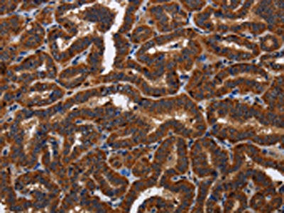 The image on the left is immunohistochemistry of paraffin-embedded Human thyroid cancer tissue using the antibody Antibody) at dilution 1/60, on the right is treated with fusion protein. (Original magnification: ×200)Rabbit anti-Human TICAM2 Polyclonal Antibody
