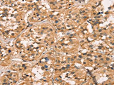 The image on the left is immunohistochemistry of paraffin-embedded Human thyroid cancer tissue using CXCR6 Antibody(CXCR6 Antibody) at dilution 1/30, on the right is treated with fusion protein. (Original magnification: ×200)Rabbit anti-Human CXCR6 Polyclonal Antibody