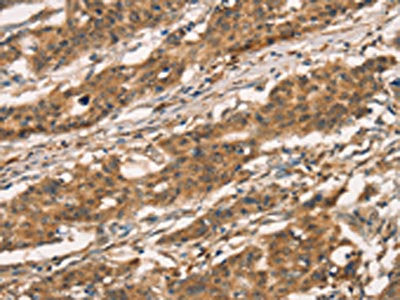 The image on the left is immunohistochemistry of paraffin-embedded Human gastic cancer tissue using the antibody Antibody) at dilution 1/30, on the right is treated with fusion protein. (Original magnification: ×200)Rabbit anti-Human CXCR6 Polyclonal Antibody