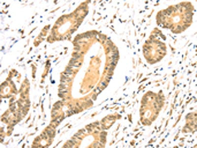 The image on the left is immunohistochemistry of paraffin-embedded Human colon cancer tissue using TSPAN13 Antibody(TSPAN13 Antibody) at dilution 1/35, on the right is treated with synthetic peptide. (Original magnification: ×200)Rabbit anti-Human TSPAN13 Polyclonal Antibody