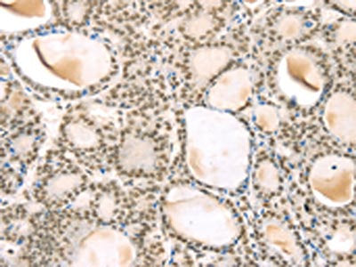 The image on the left is immunohistochemistry of paraffin-embedded Human thyroid cancer tissue using the antibody Antibody) at dilution 1/35, on the right is treated with synthetic peptide. (Original magnification: ×200)Rabbit anti-Human TSPAN13 Polyclonal Antibody