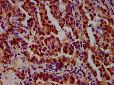 IHC image of the antibody diluted at 1:600 and staining in paraffin-embedded human lung cancer performed on a Leica BondTM system. After dewaxing and hydration, antigen retrieval was mediated by high pressure in a citrate buffer (pH 6.0). Section was blocked with 10% normal goat serum 30min at RT. Then primary antibody (1% BSA) was incubated at 4°C overnight. The primary is detected by a biotinylated secondary antibody and visualized using an HRP conjugated SP system.Rabbit anti-Human IMPDH1 Polyclonal Antibody