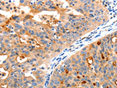 The image on the left is immunohistochemistry of paraffin-embedded Human ovarian cancer tissue using MAP2K2 Antibody(MAP2K2 Antibody) at dilution 1/20, on the right is treated with synthetic peptide. (Original magnification: ×200)