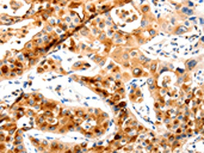 The image on the left is immunohistochemistry of paraffin-embedded Human lung cancer tissue using the antibody Antibody) at dilution 1/20, on the right is treated with synthetic peptide. (Original magnification: ×200)