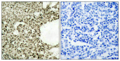 Immunohistochemical analysis of paraffin-embedded human breast carcinoma tissue using STAT1(Phospho-Ser727) Antibody(left) or the same antibody preincubated with blocking peptide(right).Rabbit anti-Human STAT1 Polyclonal Antibody