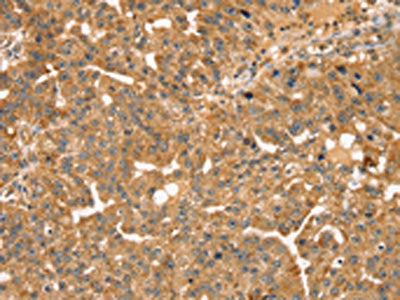 The image on the left is immunohistochemistry of paraffin-embedded Human breast cancer tissue using STX10 Antibody(STX10 Antibody) at dilution 1/35, on the right is treated with fusion protein. (Original magnification: ×200)Rabbit anti-Human STX10 Polyclonal Antibody