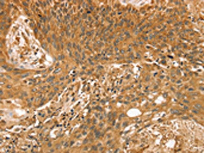 The image on the left is immunohistochemistry of paraffin-embedded Human esophagus cancer tissue using the antibody Antibody) at dilution 1/35, on the right is treated with fusion protein. (Original magnification: ×200)Rabbit anti-Human STX10 Polyclonal Antibody