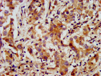 IHC image of the antibody diluted at 1:200 and staining in paraffin-embedded human liver cancer performed on a Leica BondTM system. After dewaxing and hydration, antigen retrieval was mediated by high pressure in a citrate buffer (pH 6.0). Section was blocked with 10% normal goat serum 30min at RT. Then primary antibody (1% BSA) was incubated at 4°C overnight. The primary is detected by a biotinylated secondary antibody and visualized using an HRP conjugated SP system.Rabbit anti-Human AMMECR1 Polyclonal Antibody