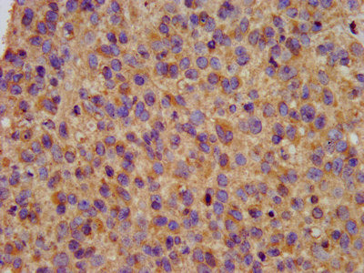 IHC image of the antibody diluted at 1:200 and staining in paraffin-embedded human glioma performed on a Leica BondTM system. After dewaxing and hydration, antigen retrieval was mediated by high pressure in a citrate buffer (pH 6.0). Section was blocked with 10% normal goat serum 30min at RT. Then primary antibody (1% BSA) was incubated at 4°C overnight. The primary is detected by a biotinylated secondary antibody and visualized using an HRP conjugated SP system.