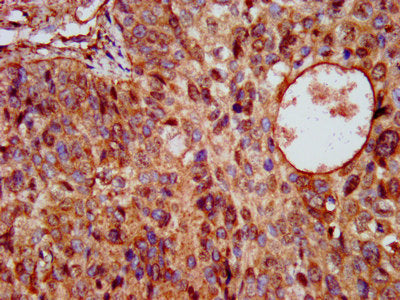 IHC image of KCNE3 Antibody diluted at 1:200 and staining in paraffin-embedded human cervical cancer performed on a Leica BondTM system. After dewaxing and hydration, antigen retrieval was mediated by high pressure in a citrate buffer (pH 6.0). Section was blocked with 10% normal goat serum 30min at RT. Then primary antibody (1% BSA) was incubated at 4°C overnight. The primary is detected by a biotinylated secondary antibody and visualized using an HRP conjugated SP system.