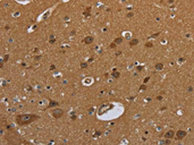 The image on the left is immunohistochemistry of paraffin-embedded Human brain  tissue using NR3C1 Antibody(NR3C1 Antibody) at dilution 1/30, on the right is treated with fusion protein. (Original magnification: ×200)Rabbit anti-Human NR3C1 Polyclonal Antibody