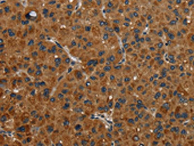 The image on the left is immunohistochemistry of paraffin-embedded Human liver cancer tissue using the antibody Antibody) at dilution 1/30, on the right is treated with fusion protein. (Original magnification: ×200)Rabbit anti-Human NR3C1 Polyclonal Antibody