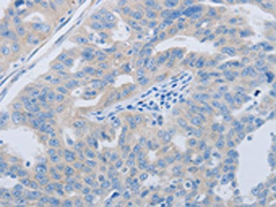 The image on the left is immunohistochemistry of paraffin-embedded Human ovarian cancer tissue using PAWR Antibody(PAWR Antibody) at dilution 1/60, on the right is treated with synthetic peptide. (Original magnification: ×200)Rabbit anti-Human PAWR Polyclonal Antibody