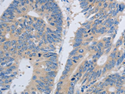 The image on the left is immunohistochemistry of paraffin-embedded Human colon cancer tissue using the antibody Antibody) at dilution 1/60, on the right is treated with synthetic peptide. (Original magnification: ×200)Rabbit anti-Human PAWR Polyclonal Antibody