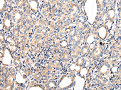 The image on the left is immunohistochemistry of paraffin-embedded Human thyroid cancer tissue using PPP5C Antibody(PPP5C Antibody) at dilution 1/20, on the right is treated with fusion protein. (Original magnification: ×200)Rabbit anti-Human PPP5C Polyclonal Antibody