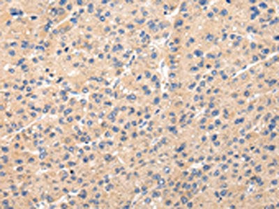 The image on the left is immunohistochemistry of paraffin-embedded Human liver cancer tissue using the antibody Antibody) at dilution 1/20, on the right is treated with fusion protein. (Original magnification: ×200)Rabbit anti-Human PPP5C Polyclonal Antibody