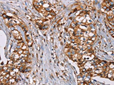 The image on the left is immunohistochemistry of paraffin-embedded Human breast cancer tissue using the antibody Antibody) at dilution 1/50, on the right is treated with fusion protein. (Original magnification: ×200)Rabbit anti-Human NDUFS1 Polyclonal Antibody
