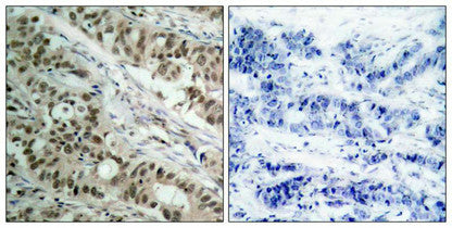 Immunohistochemical analysis of paraffin-embedded human breast carcinoma tissue using FKHR(Ab-256) Antibody(left) or the same antibody preincubated with blocking peptide(right).Rabbit anti-Human FOXO1 Polyclonal Antibody