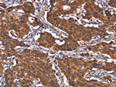 The image on the left is immunohistochemistry of paraffin-embedded Human gastric cancer tissue using KCNJ9 Antibody(KCNJ9 Antibody) at dilution 1/15, on the right is treated with synthetic peptide. (Original magnification: ×200)
