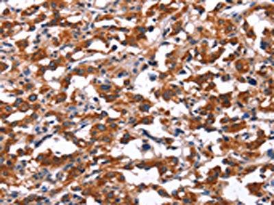 The image on the left is immunohistochemistry of paraffin-embedded Human thyroid cancer tissue using the antibody Antibody) at dilution 1/15, on the right is treated with synthetic peptide. (Original magnification: ×200)