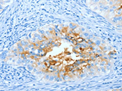 The image on the left is immunohistochemistry of paraffin-embedded Human cervical cancer tissue using CEACAM5 Antibody(CEACAM5 Antibody) at dilution 1/20, on the right is treated with fusion protein. (Original magnification: ×200)Rabbit anti-Human CEACAM5 Polyclonal Antibody