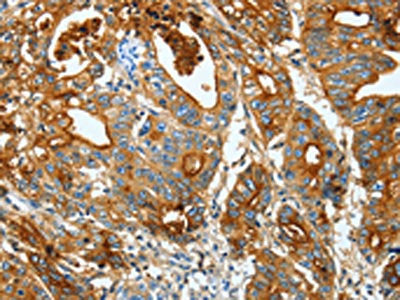 The image on the left is immunohistochemistry of paraffin-embedded Human gastic cancer tissue using the antibody Antibody) at dilution 1/20, on the right is treated with fusion protein. (Original magnification: ×200)Rabbit anti-Human CEACAM5 Polyclonal Antibody