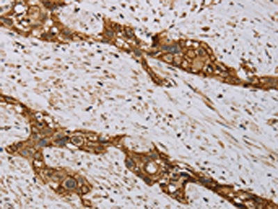 The image on the left is immunohistochemistry of paraffin-embedded Human esophagus cancer tissue using MVK Antibody(MVK Antibody) at dilution 1/20, on the right is treated with fusion protein. (Original magnification: ×200)Rabbit anti-Human MVK Polyclonal Antibody